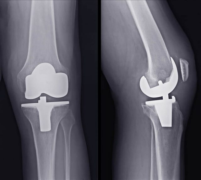 Total knee replacement x-ray