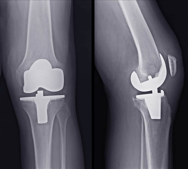 Albums 102+ Images pictures of total knee replacement Superb