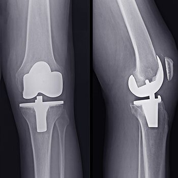 total knee replacement xray