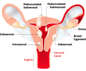 31 30 Minute Do hips get wider after hysterectomy Workout Today