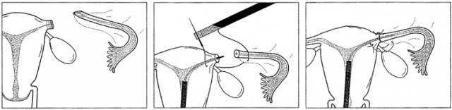 Removing Essure via Uterine Preserving Surgery