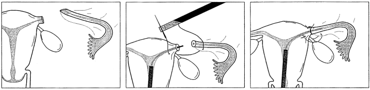 Removing Essure via Uterine Preserving Surgery