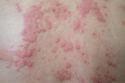 adult heat rash on neck