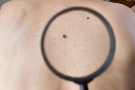 Magnifying glass studying melanoma