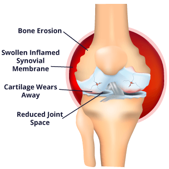 Rheumatoid Arthritis and its effect on your body