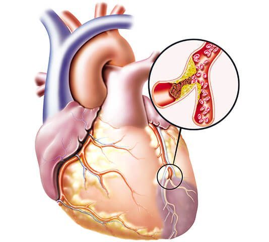 Thrombus Formation in the Heart