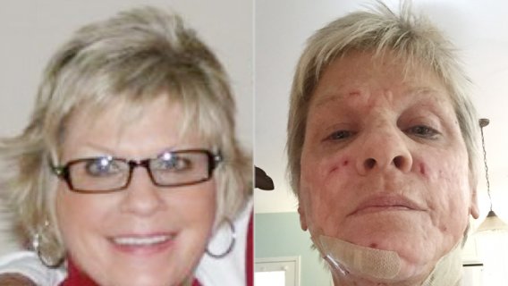 Wormlike Growths Ruin Life of Cosmetic Surgery Patient