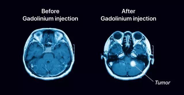 Gadolinium for MRI scanning.