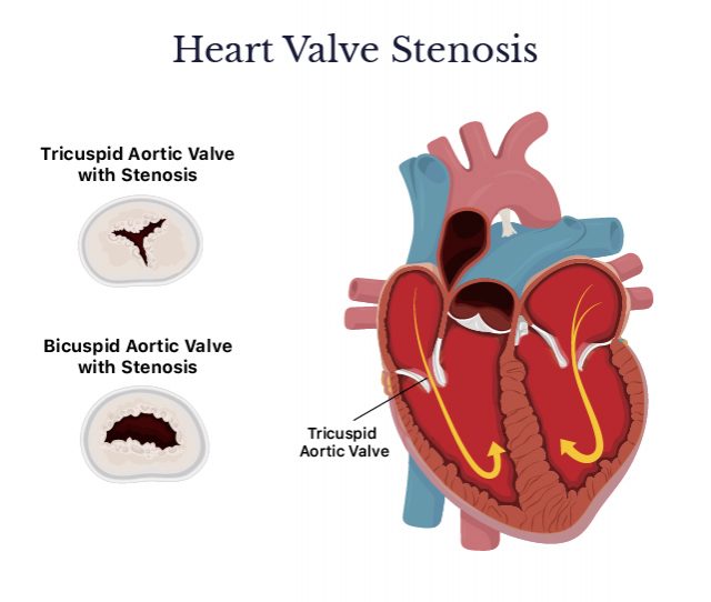 Sténose valvulaire cardiaque