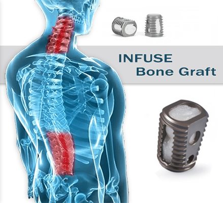 Infuse Bone Graft Study Infuse Bone Graft and Spine illustration