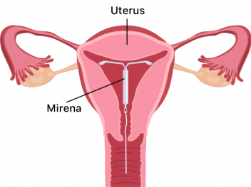Mirena Placement Diagram