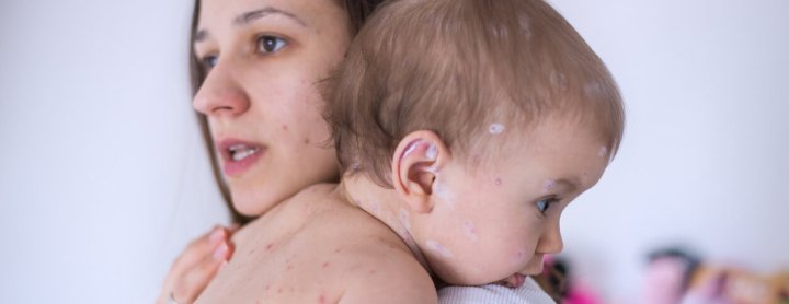 Mother holds child with chickenpox