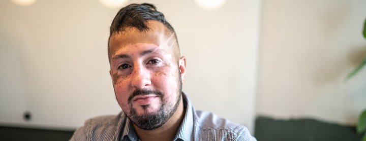 Man with vitiligo on face