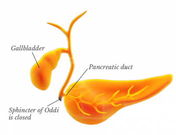 Sphincter of Oddi Spasm infographic