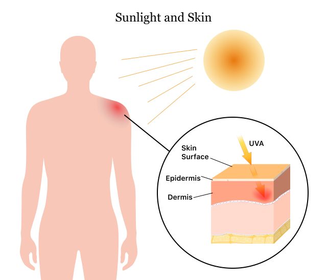 How sunlight causes sunburn on skin