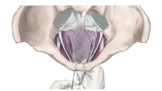 FDA Stops Sales of Transvaginal Mesh for Pelvic Organ Prolapse