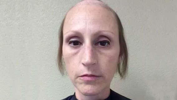 Breast Cancer Survivor Files Permanent Hair Loss Lawsuit