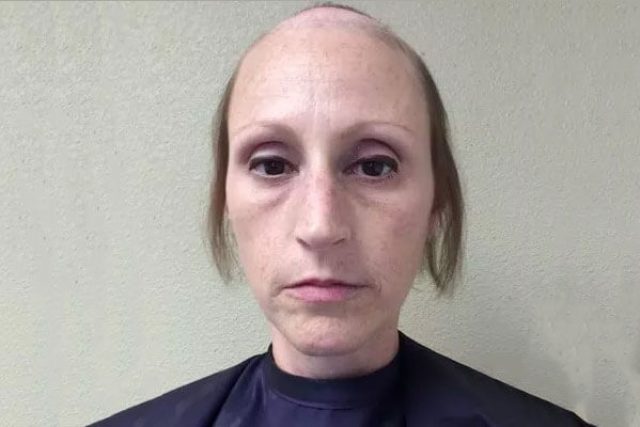 Breast Cancer Survivor Files Permanent Hair Loss Lawsuit