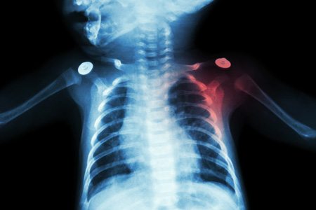Baby X-Ray Highlighting Shoulder Damage