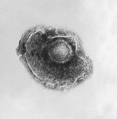 chicken-pox Microscopic view of Chickenpox