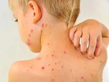 Small Child with Chickenpox Outbreak
