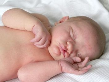 Newborn with Cleft Lip