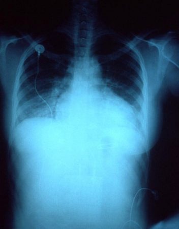 X-ray of woman with congestive heart failure