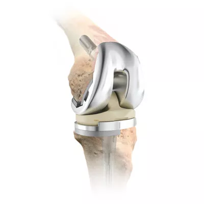 DePuy Attune Knee