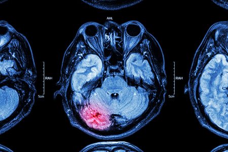 Stroke Brain Scan