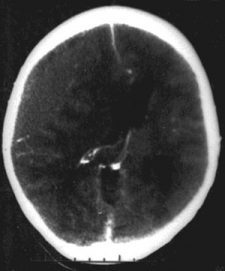 epidural hematoma x-ray