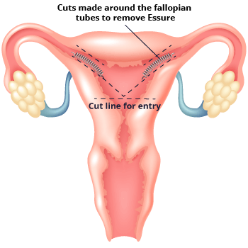 Diagram Of Essure Removal