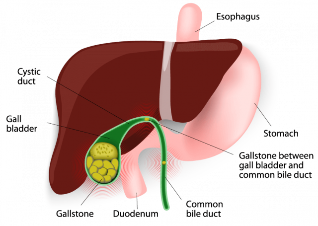 Illustration showing gallstone obstructions