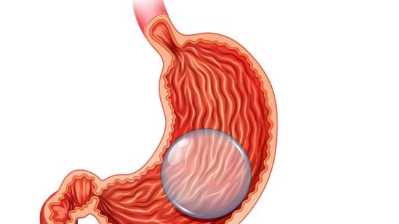 12 Deaths Reported with Weight Loss Gastric Balloons