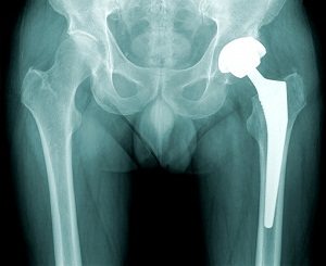 hip implant in women xray of a woman with a hip implant