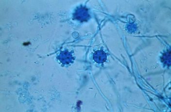 Photomicrograph of a histoplasmosis infection.