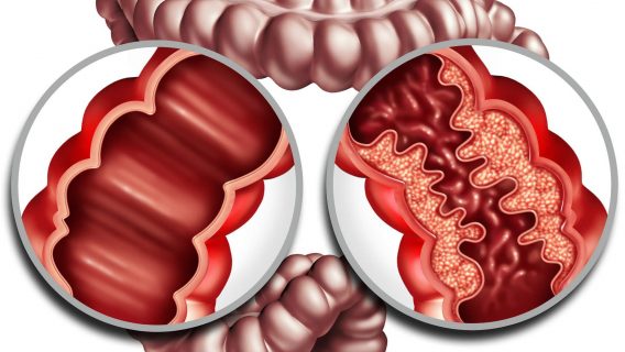 Crohn’s Disease
