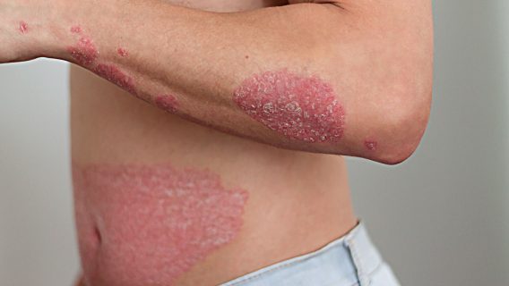 Psoriasis