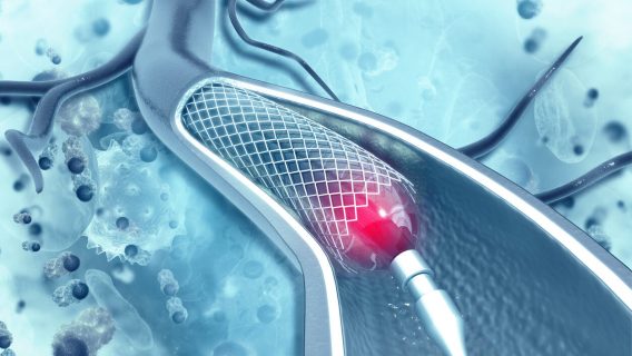 Ten Injuries and One Death Lead to Medtronic Brain Stent Recall