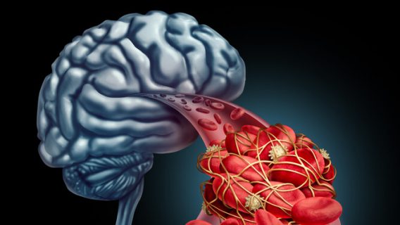 Study: Antidepressants Increase Risk of Bleeding in the Brain and Stroke