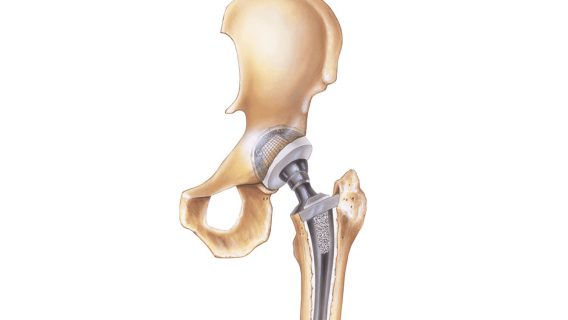 Hip Replacement