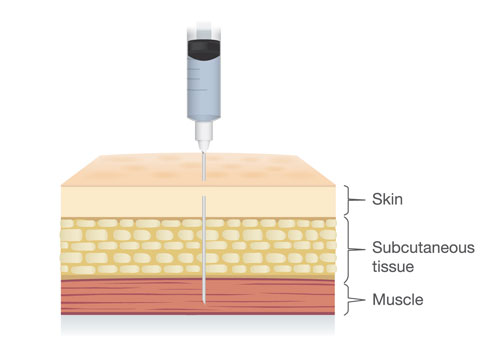 Intramuscular Injection