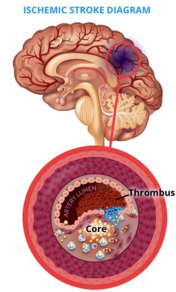 Ischemic Stroke Occur in the Thrombus
