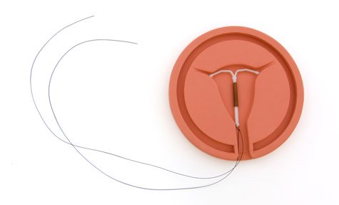 How Mirena is Implanted