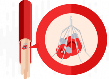 IVC Filter Removal