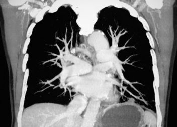 Pulmonary Embolism