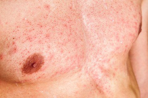 Hives on Man's Chest