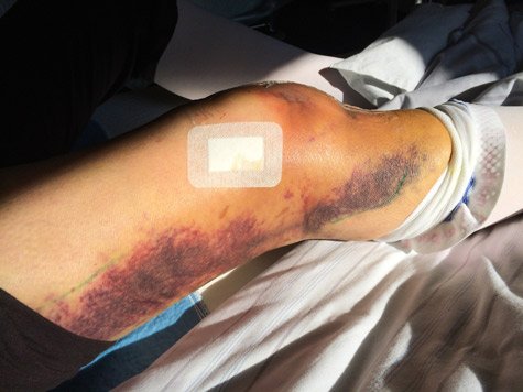 Bruised Knee with Bandage