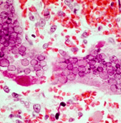 measles Microscopic view of Measles