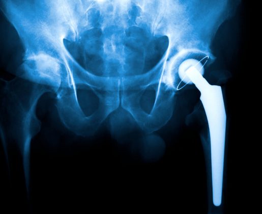 Former News Anchor Warns People About Metal Hip Implants