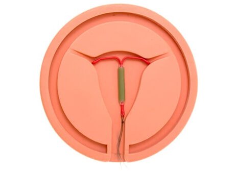 Mirena IUD Birth Control